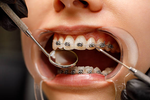 istock Detailed dental checkup with braces and instruments 2216655782