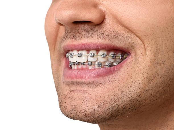 istock Smiling man with dental braces on white background, closeup 2216695807