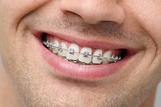 istock Smiling man with dental braces, closeup view 2216696021