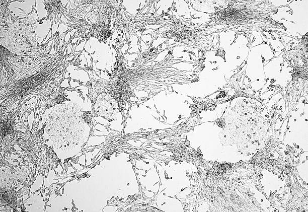 Glioblastoma cell culture. Human malignant astrocytoma cells under a microscope.