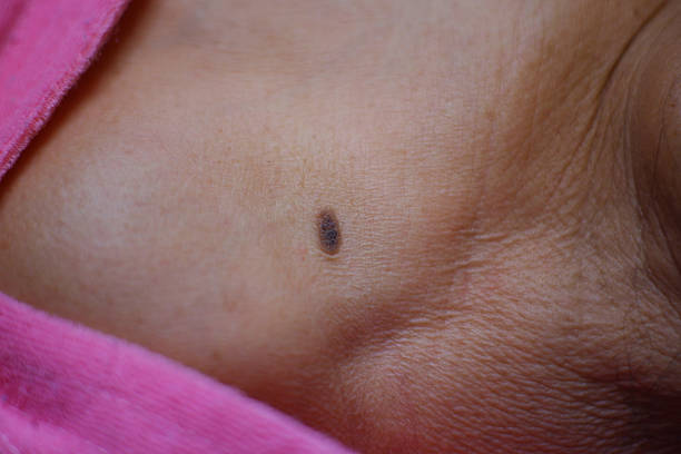 istock seborrheic keratosis or wart Shoulder and chest area 2216797418