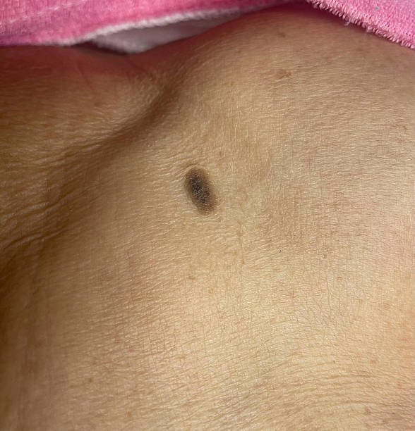 istock seborrheic keratosis or wart Shoulder and chest area 2216797423