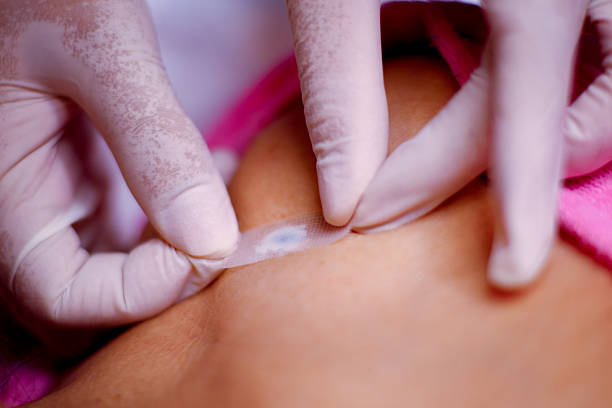 istock Procedure for applying anesthesia to moles and warts 2216797709