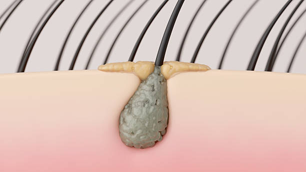 Oily Scalp and Clogged Follicles Causing Weak Hair