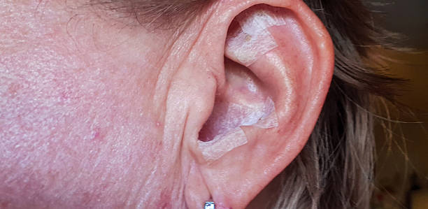istock Acupuncture with millet grain in the ear 2216873500