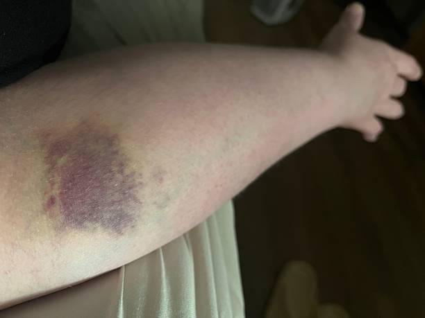istock Bruising caused by blood test needles on inner arm 2216908508