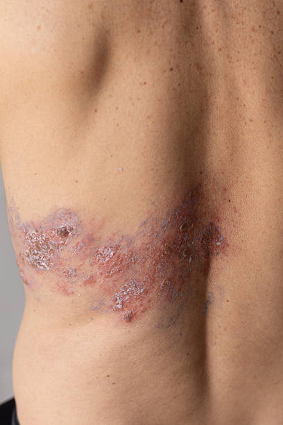 istock Shingles (Herpes Zoster) Rash on an Adult Male Torso 2216912633