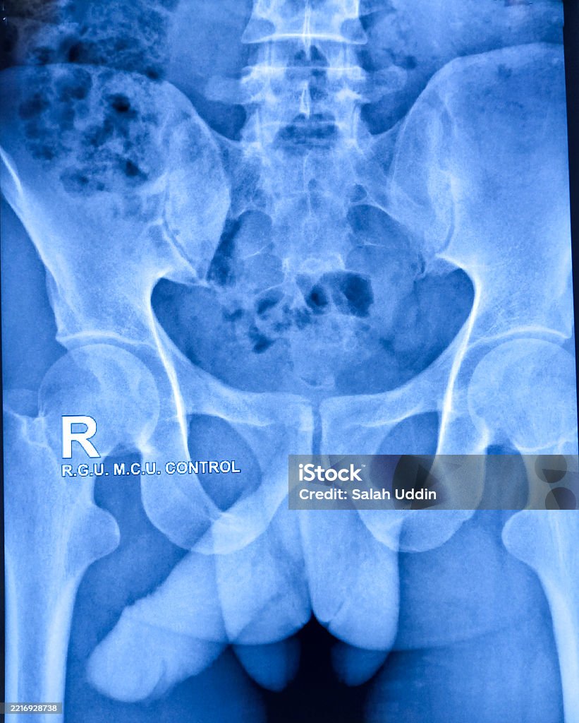 Ir Retrograde Urethrogram Xray Of The Human Retrograde Urethrogram And Micturating ...