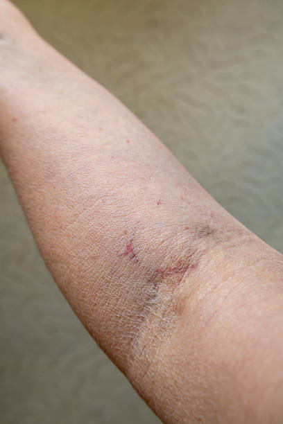 istock Bruised forearm after blood draw procedure 2217098929