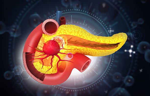 istock Human pancreas cancer concept 2217099425