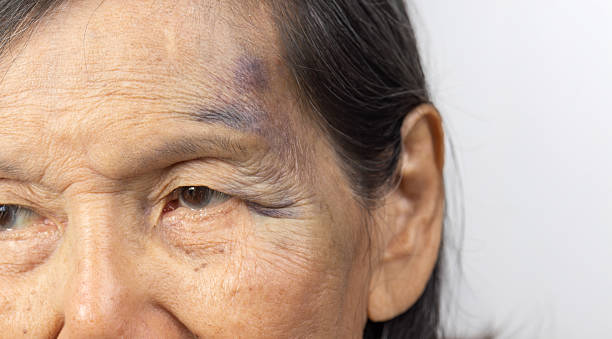 istock Elderly woman Have A Bruise on Face After Falling in Bathroom. 2217254825