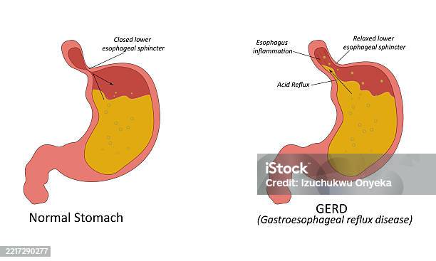 Gerdft Gastroesophageal Reflux Disease Vector Illustration Stock Illustration ...