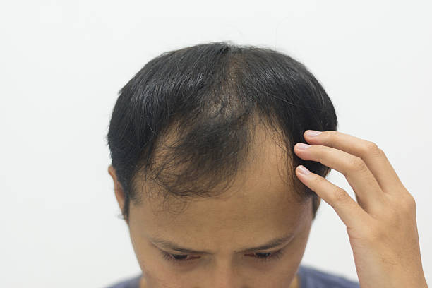 Young Asian men experience hair loss, showing his bald pattern