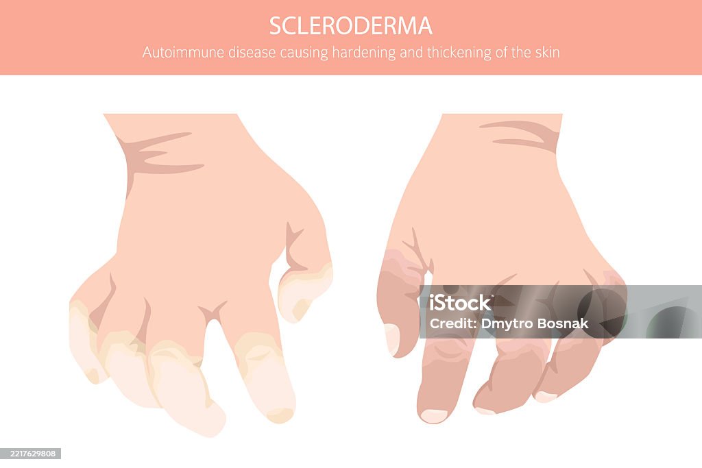 Scleroderma Rash Hand Scleroderma Skin Diseases Medical Infographic Design Stock Illustration ...