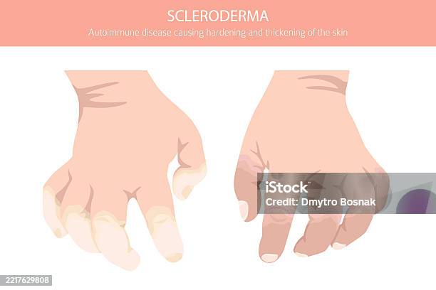 Scleroderma Skin Pattern Scleroderma Skin Diseases Medical Infographic Design Stock Illustration ...