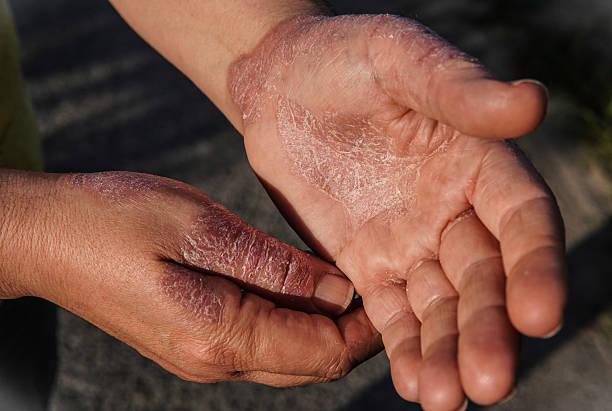 istock Skin rash caused by eczema 2217858076