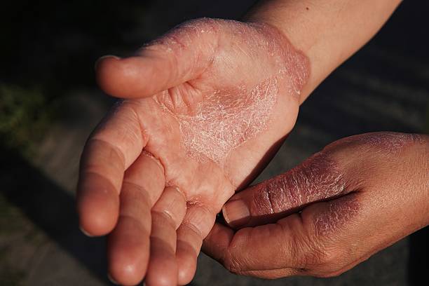 istock Skin rash caused by eczema 2217858081