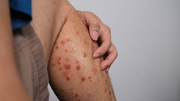 istock The early signs Psoriasis. 2217928169
