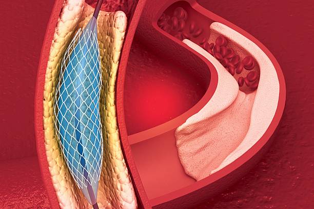 istock Human heart stent implantation concept 2217934564