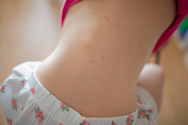 istock Chickenpox rash on child’s back, close-up view. Red spots and early blisters typical for varicella virus infection. Pediatric skin disease symptoms. 2218130605