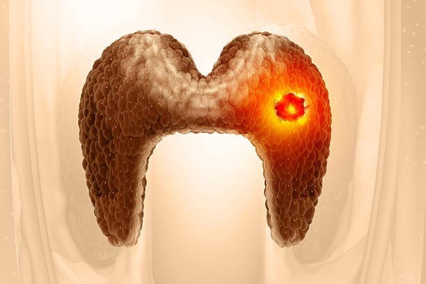 istock Thyroid gland cancer. showing thyroid gland with tumor. 3d illustration 2218264007