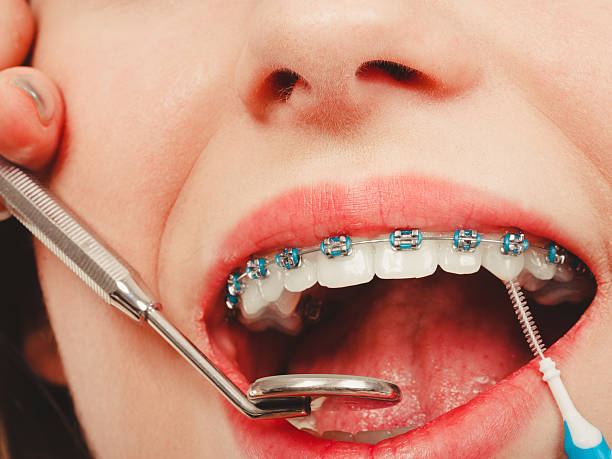 istock Woman smiling cleaning teeth with braces 2218421694