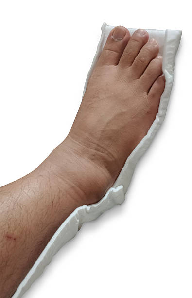 istock Swollen man's ankle in a white soft cast on a white background, painful, accident, body, copy space 2218847149