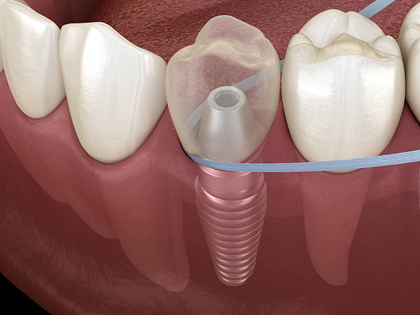 Implant tooth cleaning with dental floss. 3D illustration
