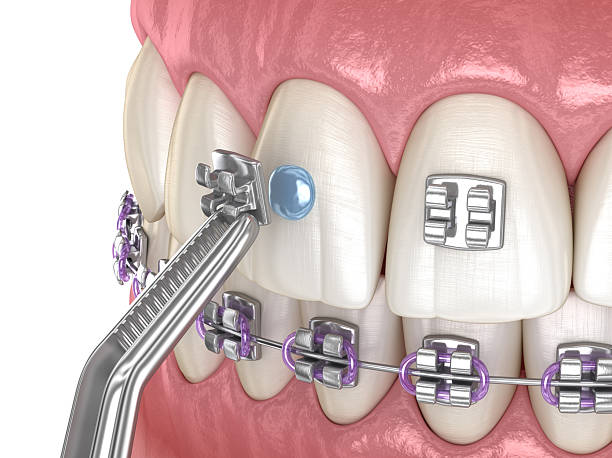 istock Metal braces installation process. Dental 3D illustration 2218903164