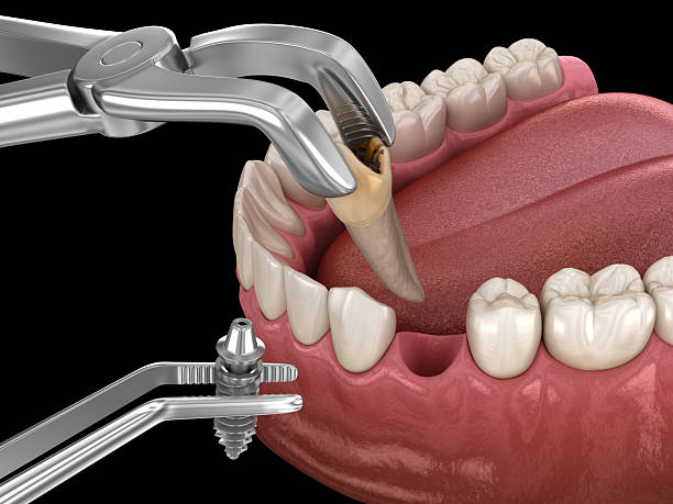 istock Extraction and Implantation, complex immediate surgery. Medically accurate 3D illustration of dental treatment 2218903169