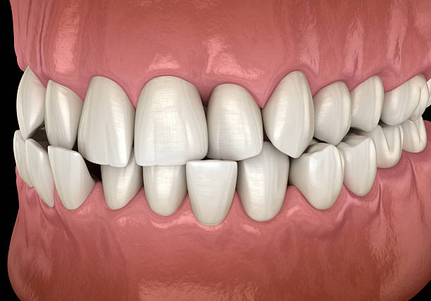 istock Abnormal teeth position, dental orthodontic.3D illustration 2218903177