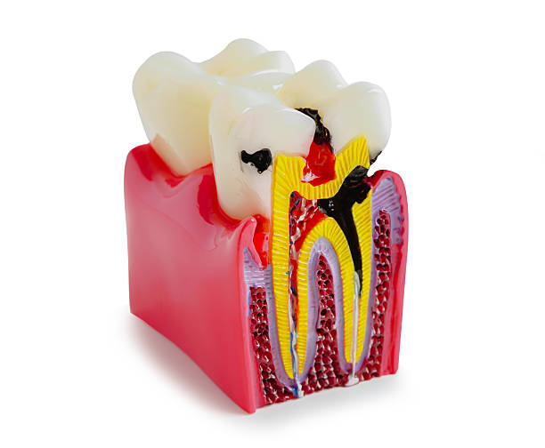 istock Dental tooth root canal model isolated on white background with clipping path. 2219027301