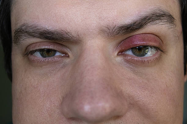 istock Man suffering from upper eyelid swelling and redness. Common symptom of stye, blepharitis or chalazion. 2219060737