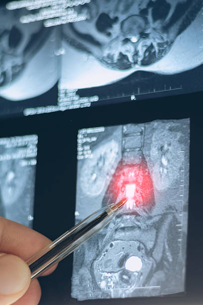 istock Examination vertical mri of inside herniated vertebral disk in spine, close up x-ray view. 2219168346