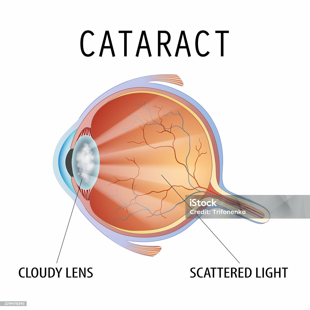 Cataract Structure Human Eye With Cataract Eyeball With A Cloudy Lens Stock Illustration ...