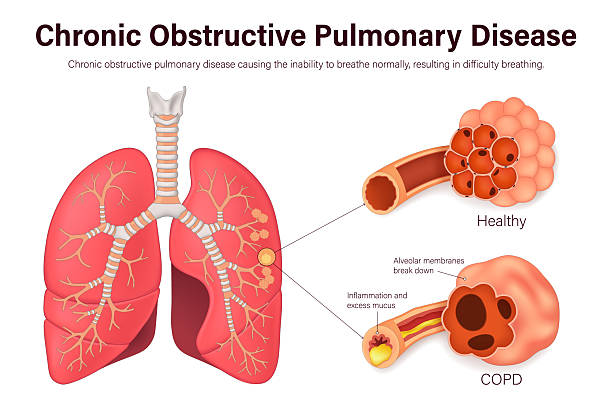 bildbanksillustrationer, clip art samt tecknat material och ikoner med chronic obstructive pulmonary disease (copd). comparison between normal bronchus and alveoli with bronchitis and emphysema. human respiratory system. - kol