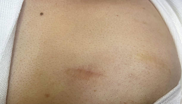 istock Keloid scars before and after plasma treatment 2219758311