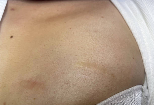 istock Keloid scars before and after plasma treatment 2219758313