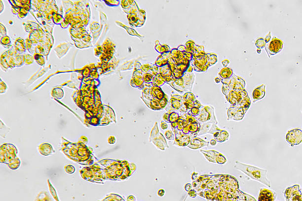 Melanoma metastasis cells in the human brain. Metastasis cell culture under a microscope.