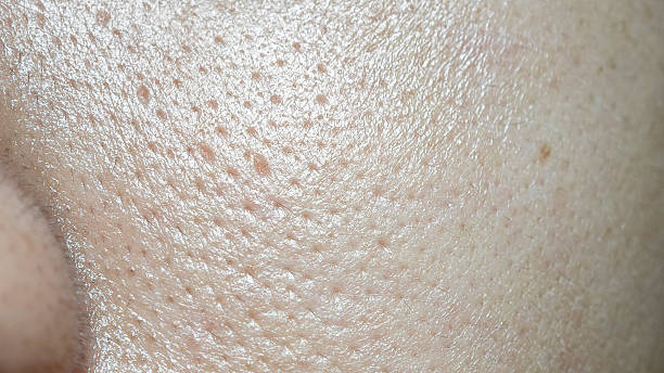 istock Clogged pores. Problematic skin. Greasy oily skin type. 2219959273