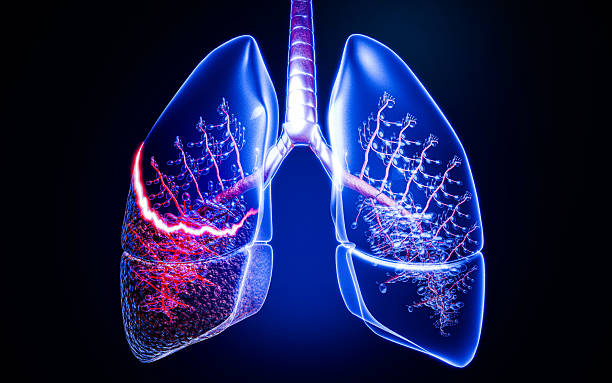 istock Lung cancer caused by chronic smoking, illustrating diseased, tar-covered lungs, carcinogen damage, and respiratory failure risks for smokers, raising awareness about health hazards. 3D Rendering 2220040089