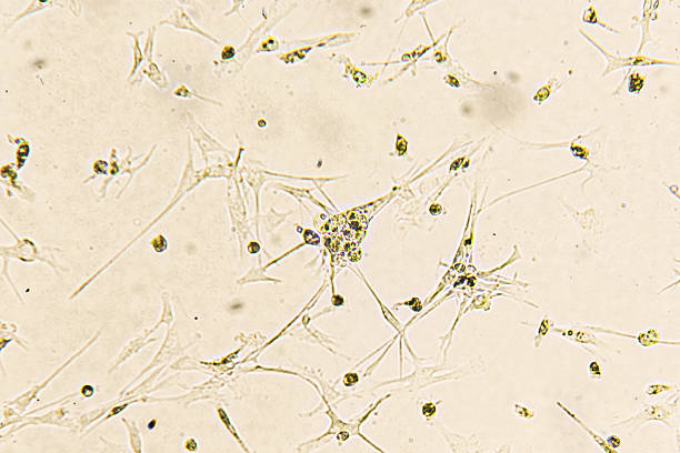 Glioblastoma cell culture. Human glioma cells under magnification.