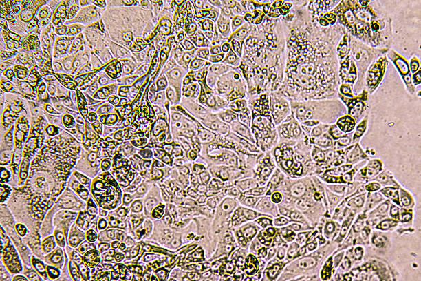 Glioblastoma cell culture. Human glioma cells under magnification.