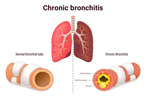 Bronchitis Visual Chronic Bronchitis Comparison Between Normal Bronchial Tube And Chronic ...