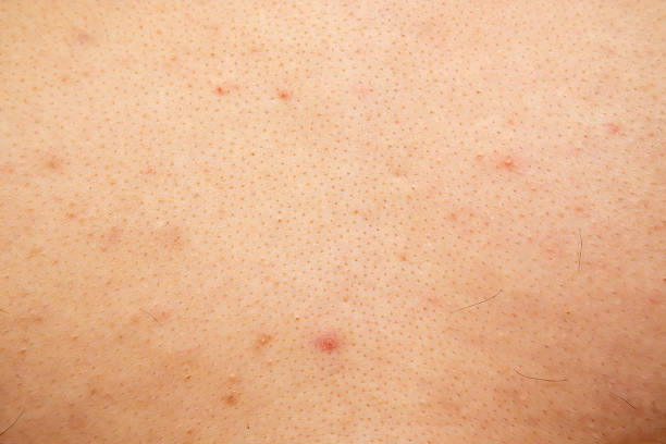Red Skin Background 50+ Red Skin Texture Stock Photos, Pictures & Royalty-Free Images - iStock
