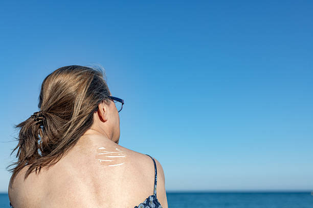Altea. Alicante. Spain. Mature woman applying sunscreen lotion on her back, looking at the sea on a sunny day, protecting her skin from sunburn