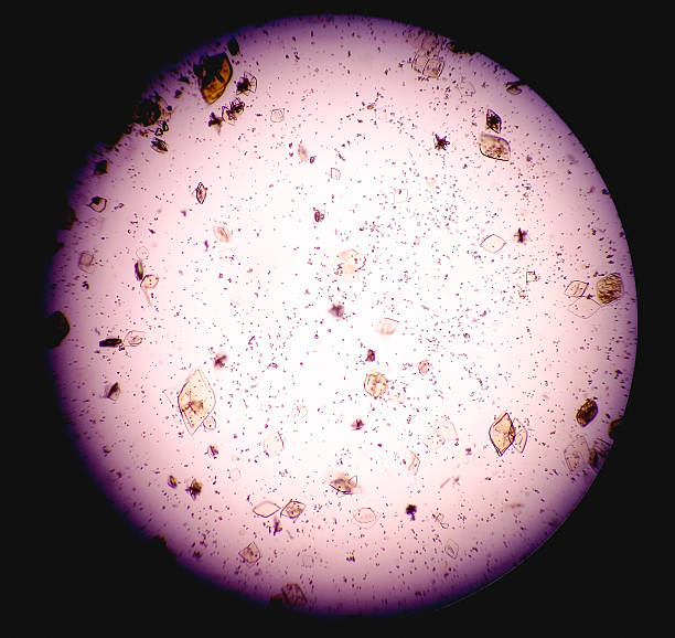 istock Urine Test Microscopic urinalysis, Uric Acid, Calcium oxalate. 2220911319