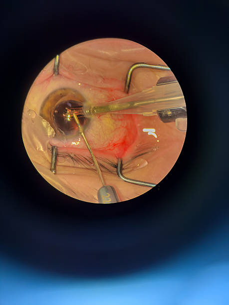 istock Cataract Surgery on Senior Patient 2220938997