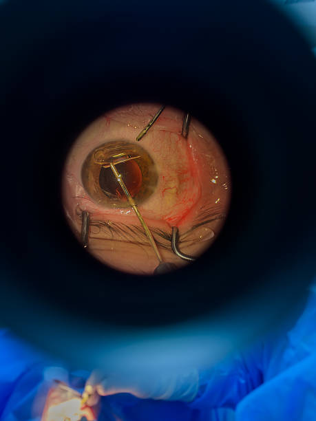 istock Cataract Surgery on Senior Patient 2220985034