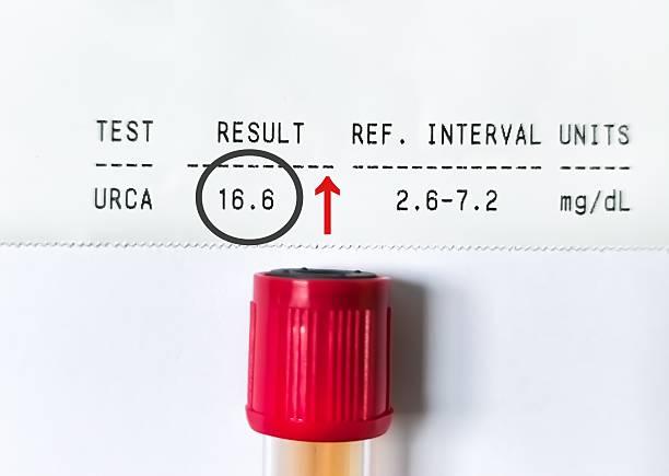 istock Blood sample with abnormal report, hyperuricemia. Gout. 2221025198